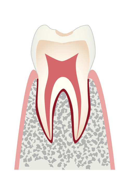 Ce（Co）：エナメル質の初期虫歯