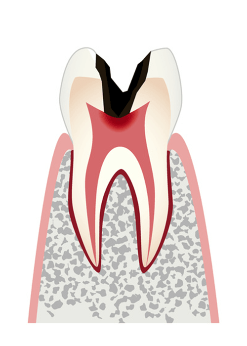C3：神経（歯髄）まで進行した虫歯