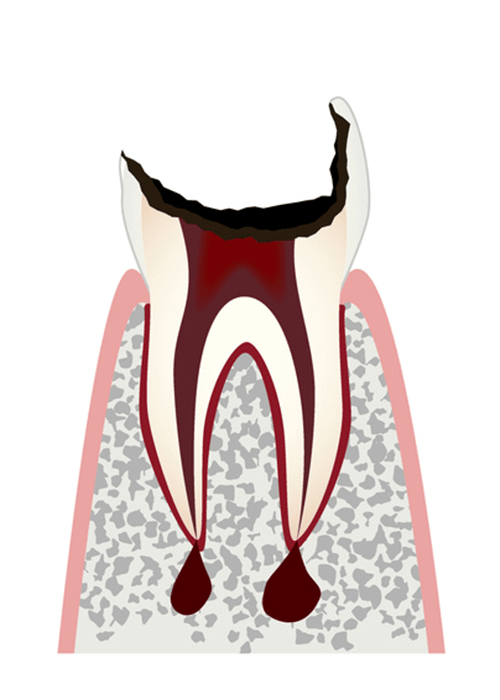 C4：歯が大きく欠損し、歯根のみの状態